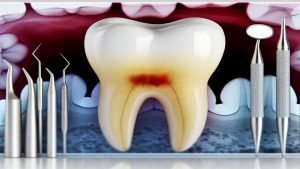 Jak wygląda ząb do leczenia kanałowego?
